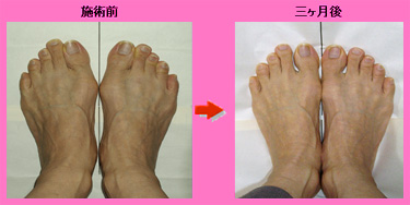 外反母趾 手術 外反母趾は自分で治せる 外反母趾 手術 外反母趾は自分で治せる